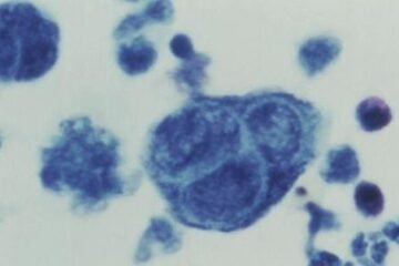 La nueva vacuna del herpes zóster reduce en casi un 90% los casos de la enfermedad entre mayores de 80 años