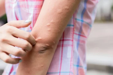 Los motivos por los que los mosquitos pican más a unas personas que a otras según un farmacéutico