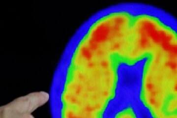 La financiación pública de los nuevos tratamientos para el alzhéimer abre una crisis entre Sanidad y la gran farmacéutica Eli Lilly