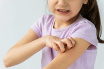 Las claves para identificar la psoriasis en niños y adolescentes