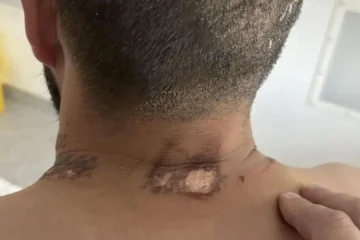 Un veterano ruso sobrevive al impacto de un rayo que le alcanzó el cuello cuando fue a pelear contra un oso en Siberia