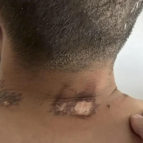 Un veterano ruso sobrevive al impacto de un rayo que le alcanzó el cuello cuando fue a pelear contra un oso en Siberia
